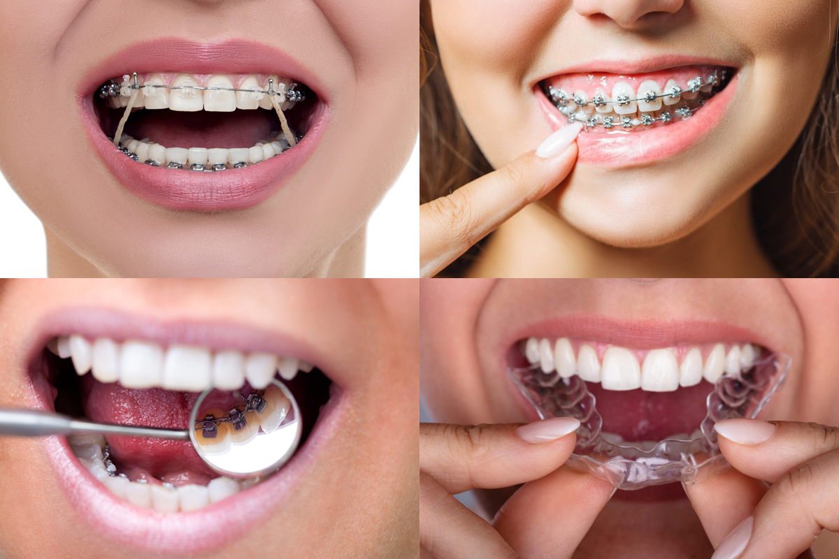 Appareil orthodontique — Orthodontie à Porto