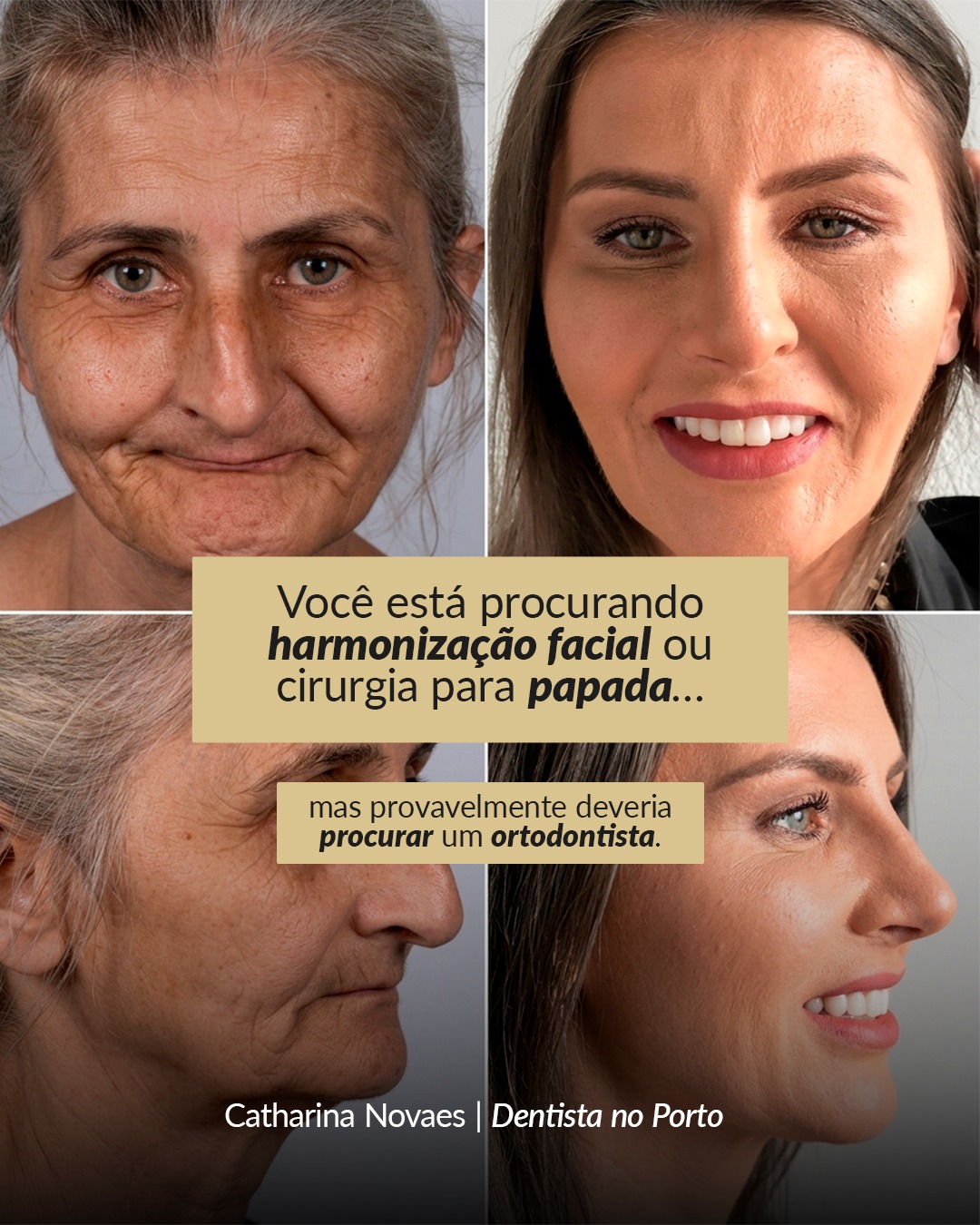 Mandíbula retraída y estética facial: estructura ósea del rostro y tratamiento correcto