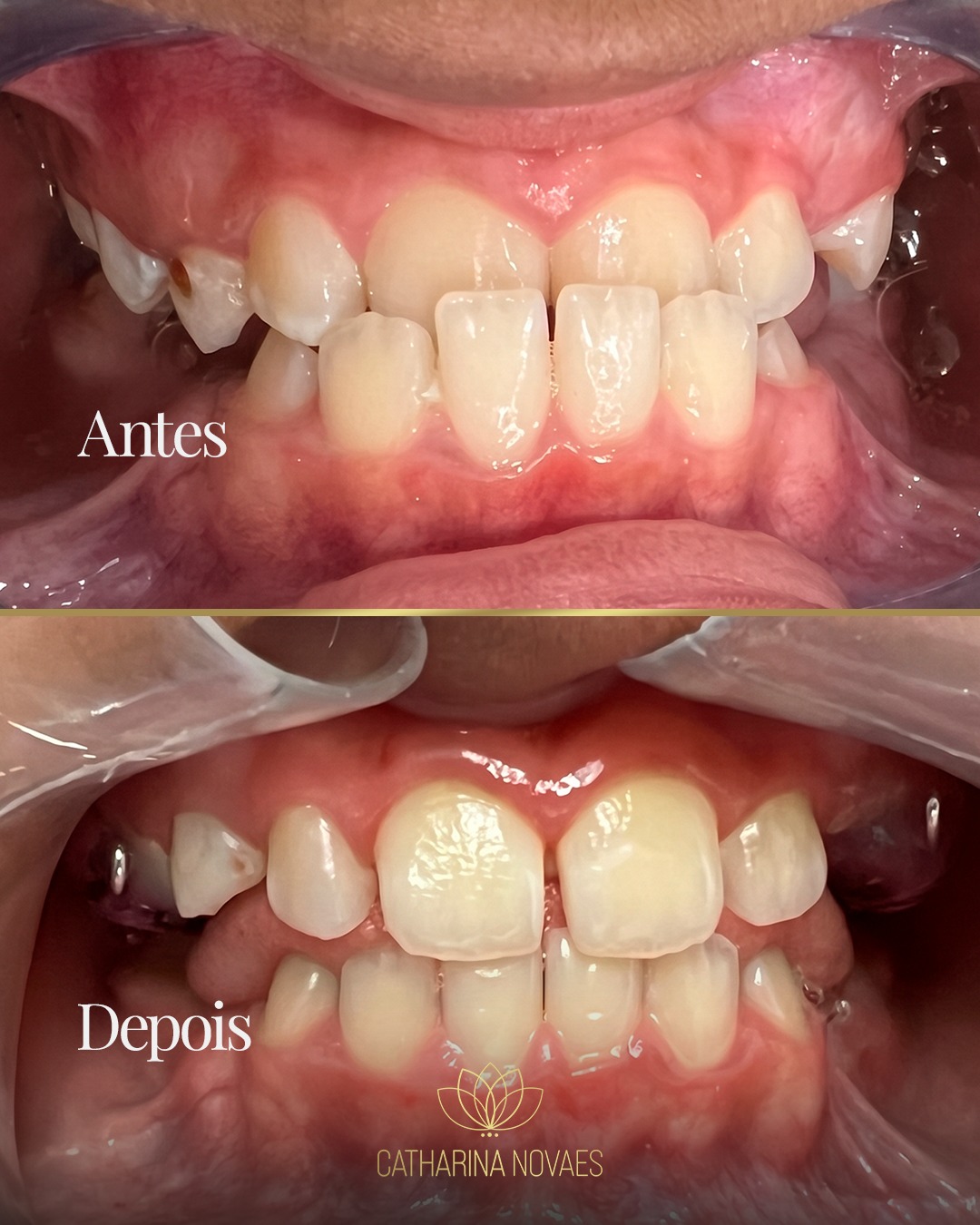 Ilustración de mordida invertida corrección ortodóntica mostrando los dientes superiores visibles en la sonrisa