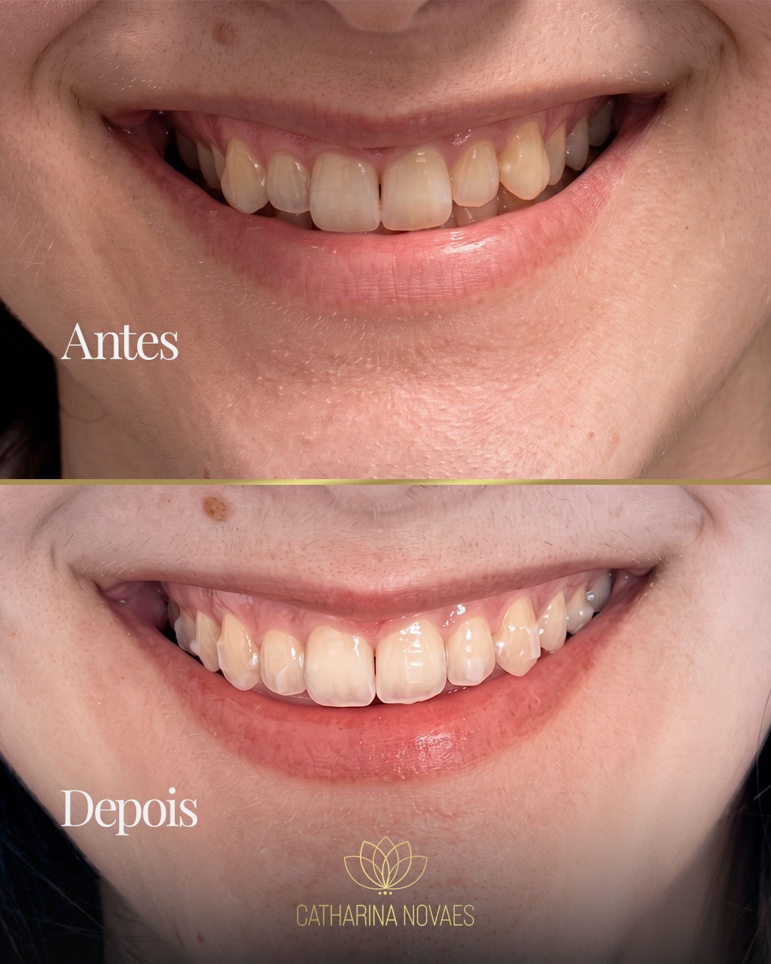 Orthodontic Smile Transformation: 15 Months of Real Change