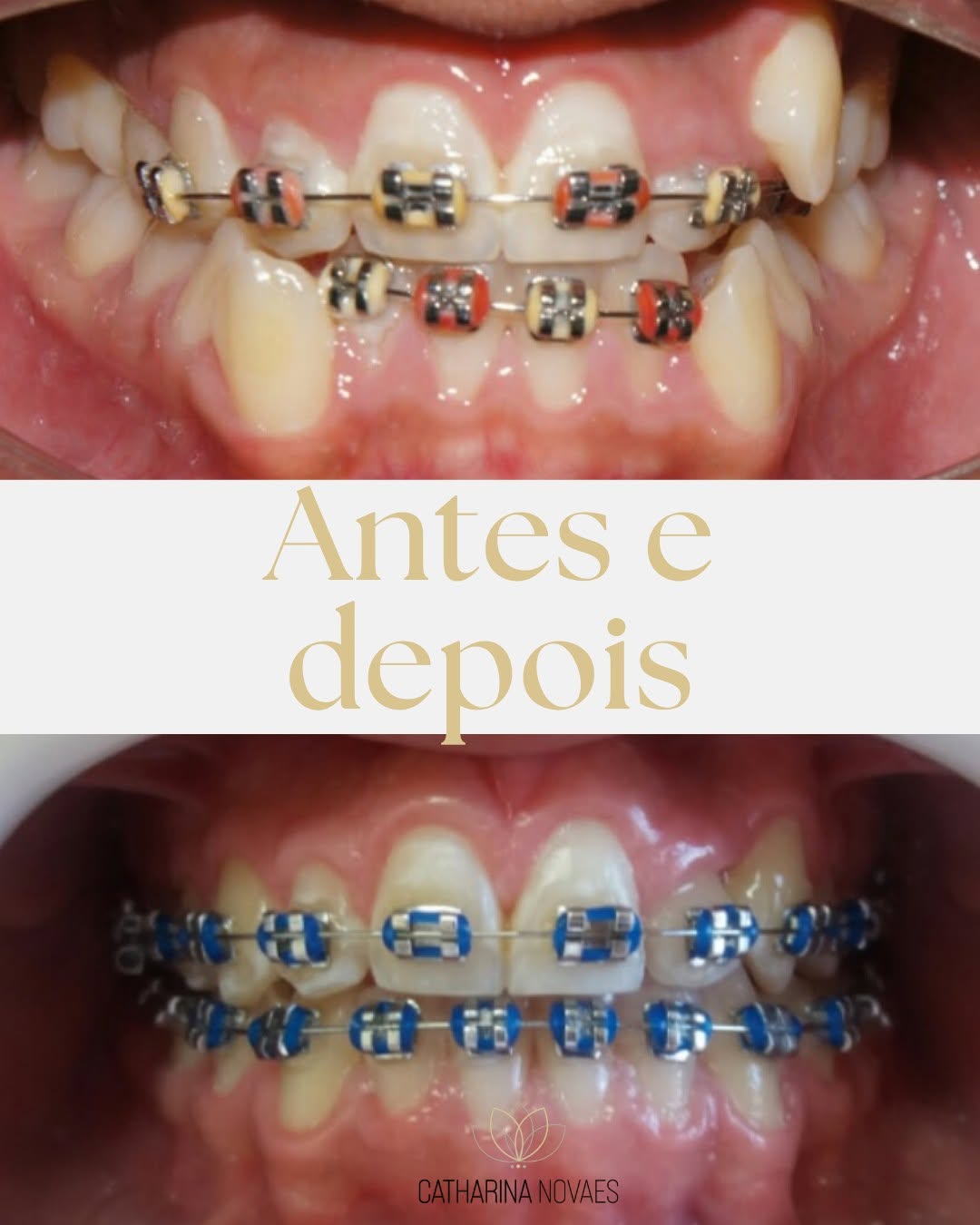 Orthodontic Treatment Transfer: How to Restart Safely