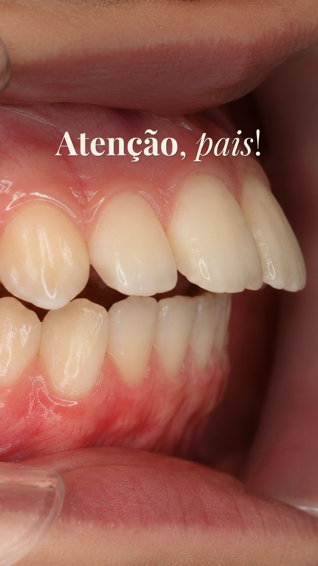 Ortodontia Preventiva e Diagnóstico Precoce em Crianças
