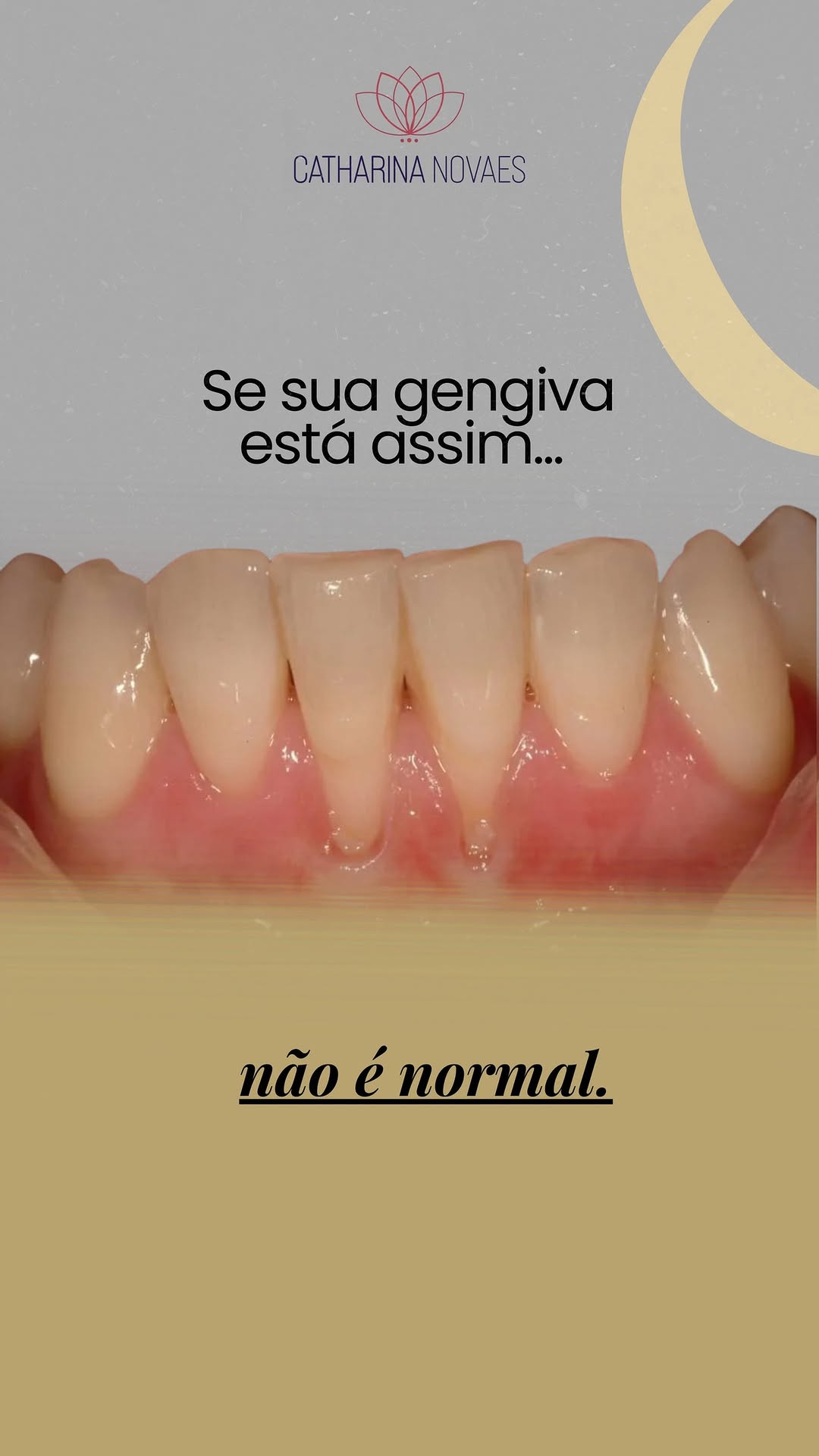 Receding gums are not normal: causes and when to act