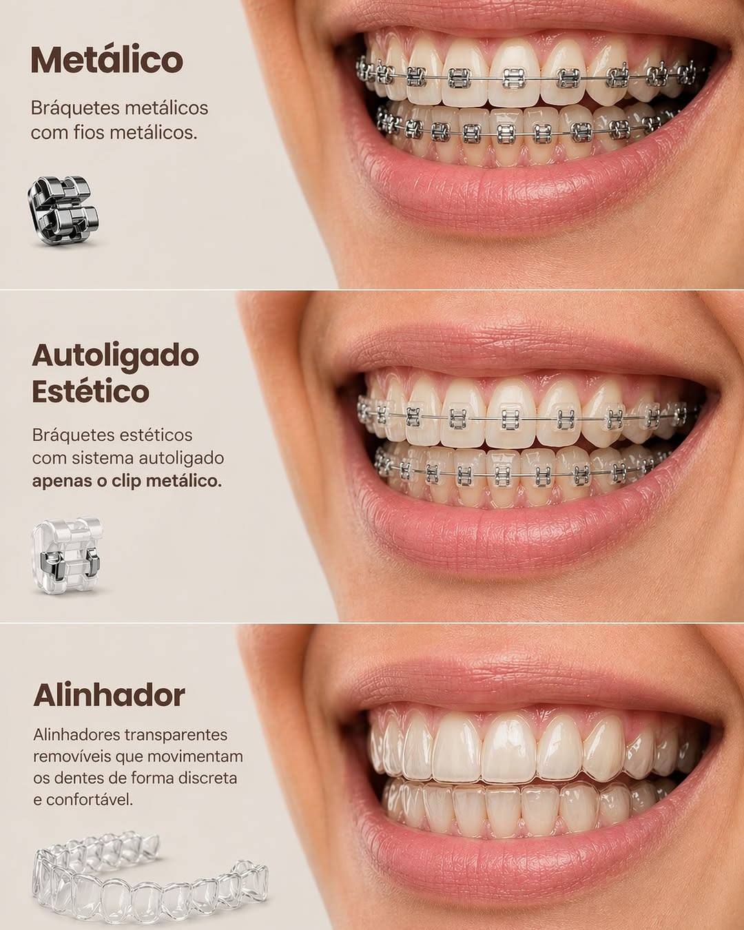 Tipos de aparelhos ortodônticos: qual é o seu?