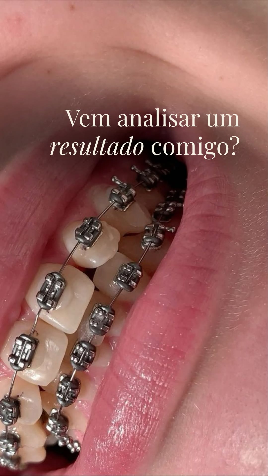 Traitement orthodontique complet : au-delà du sourire