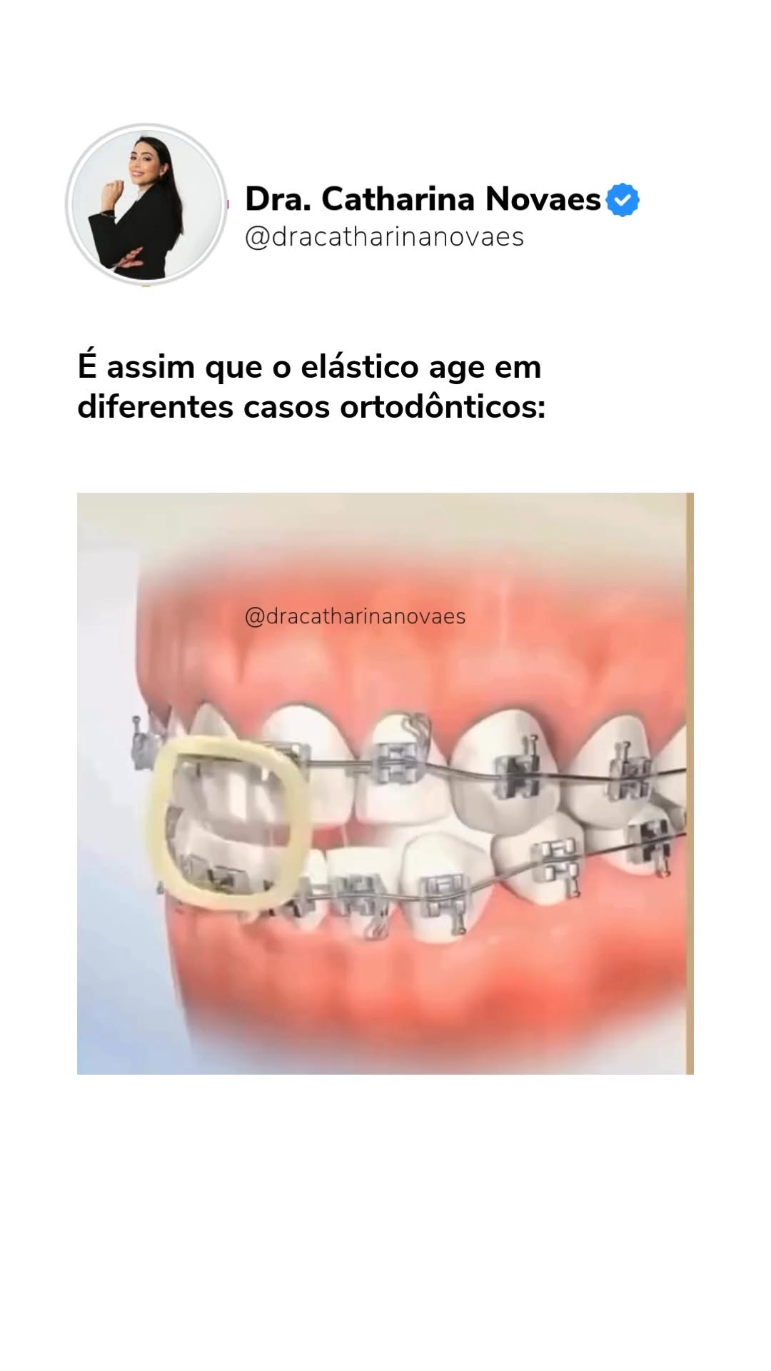 elasticos-ortodonticos-essenciais-por-que-e-como-usar Elásticos ortodônticos essenciais: por que e como usar